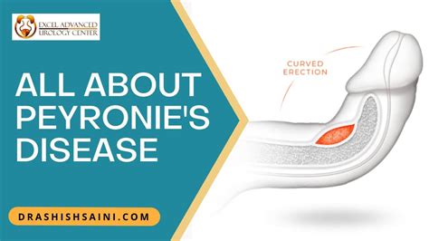 Peyronie's Disease .
